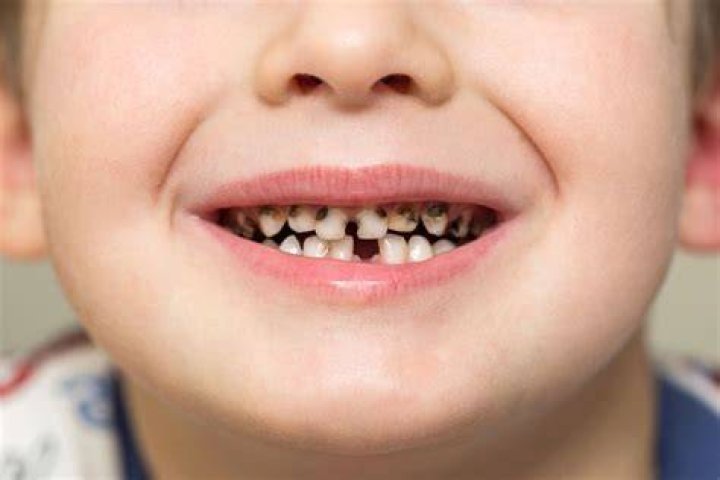 Como consertar dentes podres e 5 melhores maneiras de evitar a podridão