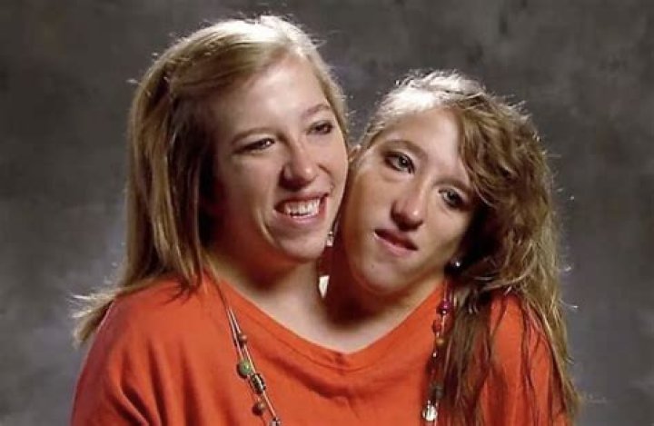 Conjoined Twins Abby And Brittany Hensel's Pregnancy Journey