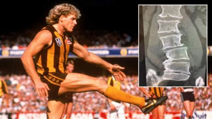 Dermott Brereton injury Former Hawks star’s horrifying back Xrays