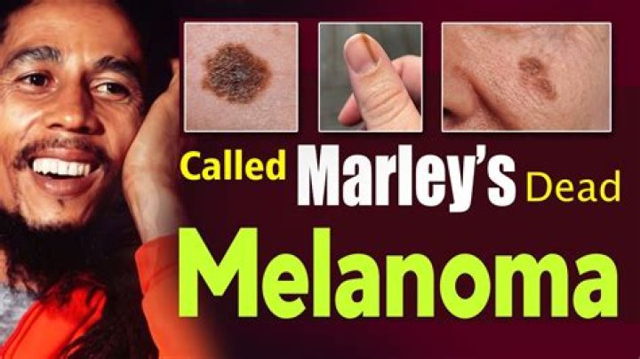 How did Bob Marley die? The US Sun
