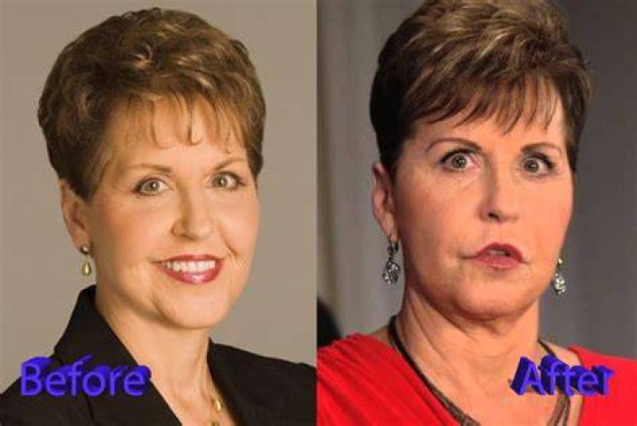 Joyce Meyer Plastic Surgery Chin Improvement, Lip augmentation, Facelift