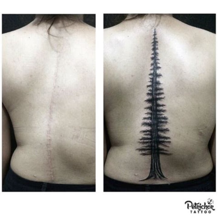 Scoliosis Surgery Scar Tattoo with Pictures Fitoont