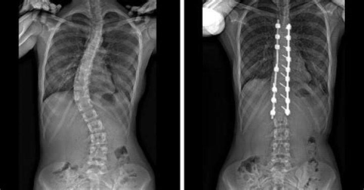 Surgical Treatment for Scoliosis OrthoInfo AAOS
