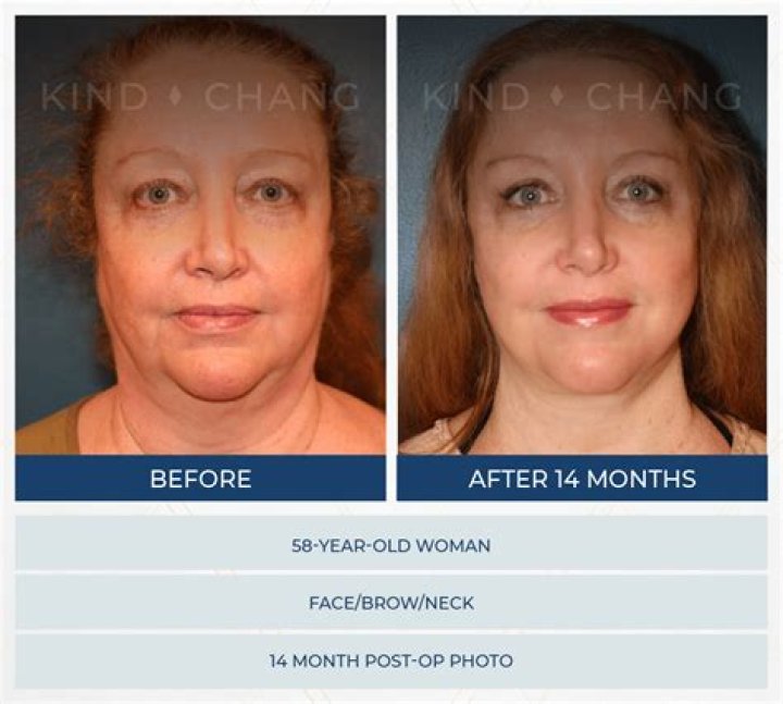 What Kind Of Plastic Surgery Did Simon Cowell Have? What Procedures Has